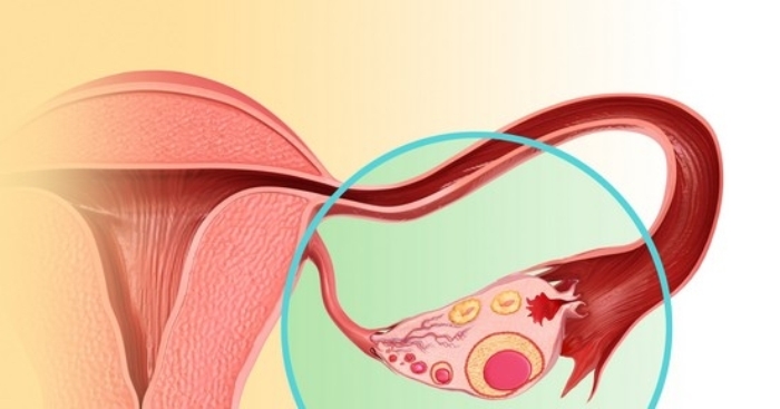 Причини, симптоми, діагностика та лікування непрохідності маткових труб
