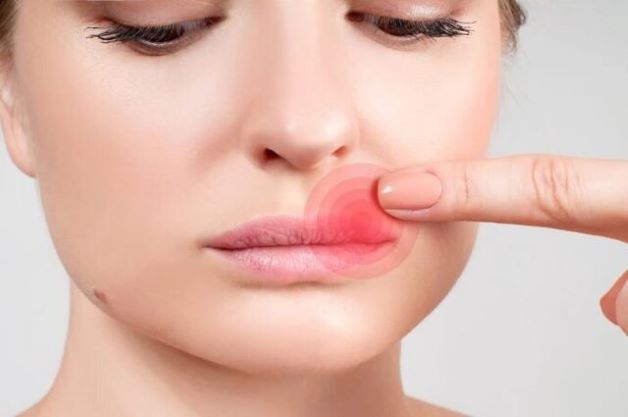 Заїди в кутиках рота – дефіцит заліза в організмі?