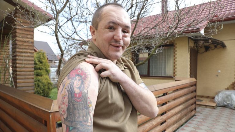 Американські журналісти розповіли, як у Франківську вертають скалічені війною обличчя (ФОТО)