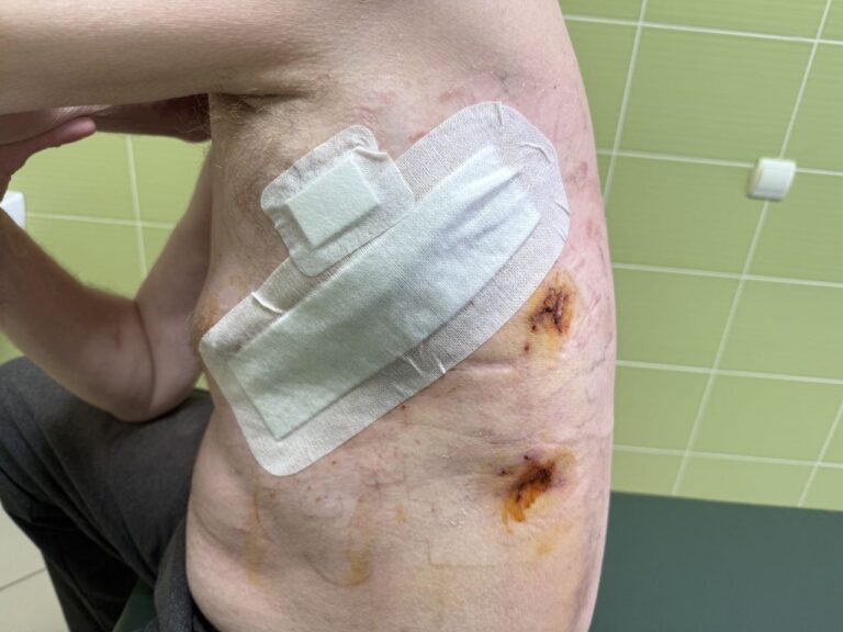 “Шансів вижити було дуже мало”: як у ЦМКЛ врятували чоловіка з розривом грудного лімфатичного протоку