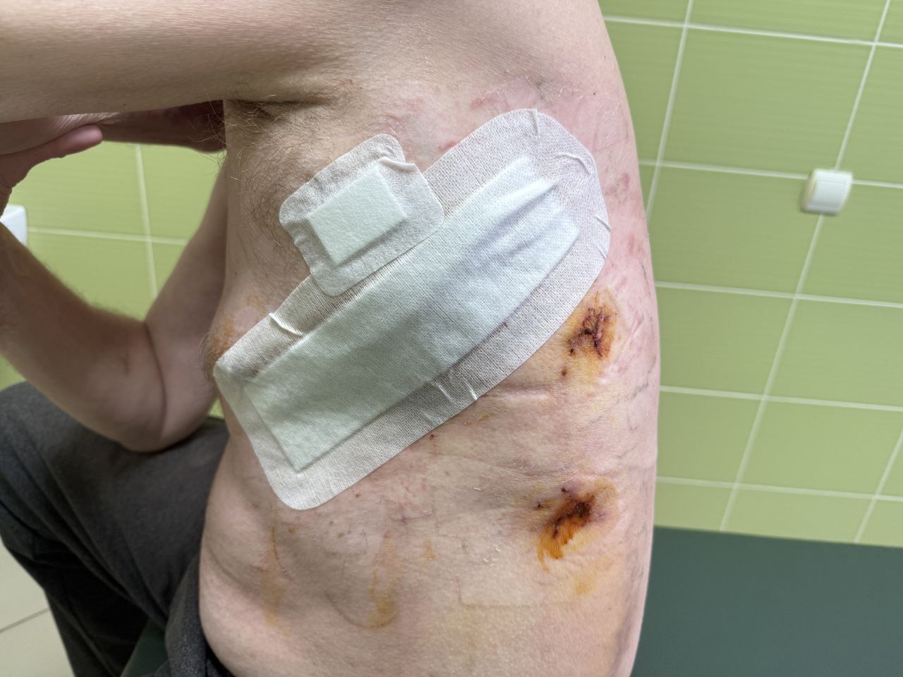 “Шансів вижити було дуже мало”: як у ЦМКЛ врятували чоловіка з розривом грудного лімфатичного протоку