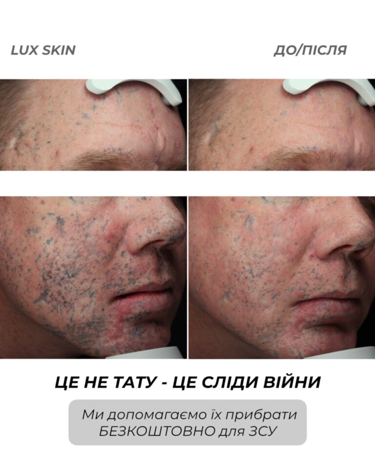 Франківська клініка безкоштовно видаляє “порохові татуювання” воїнам: історія одного пацієнта (ФОТО)