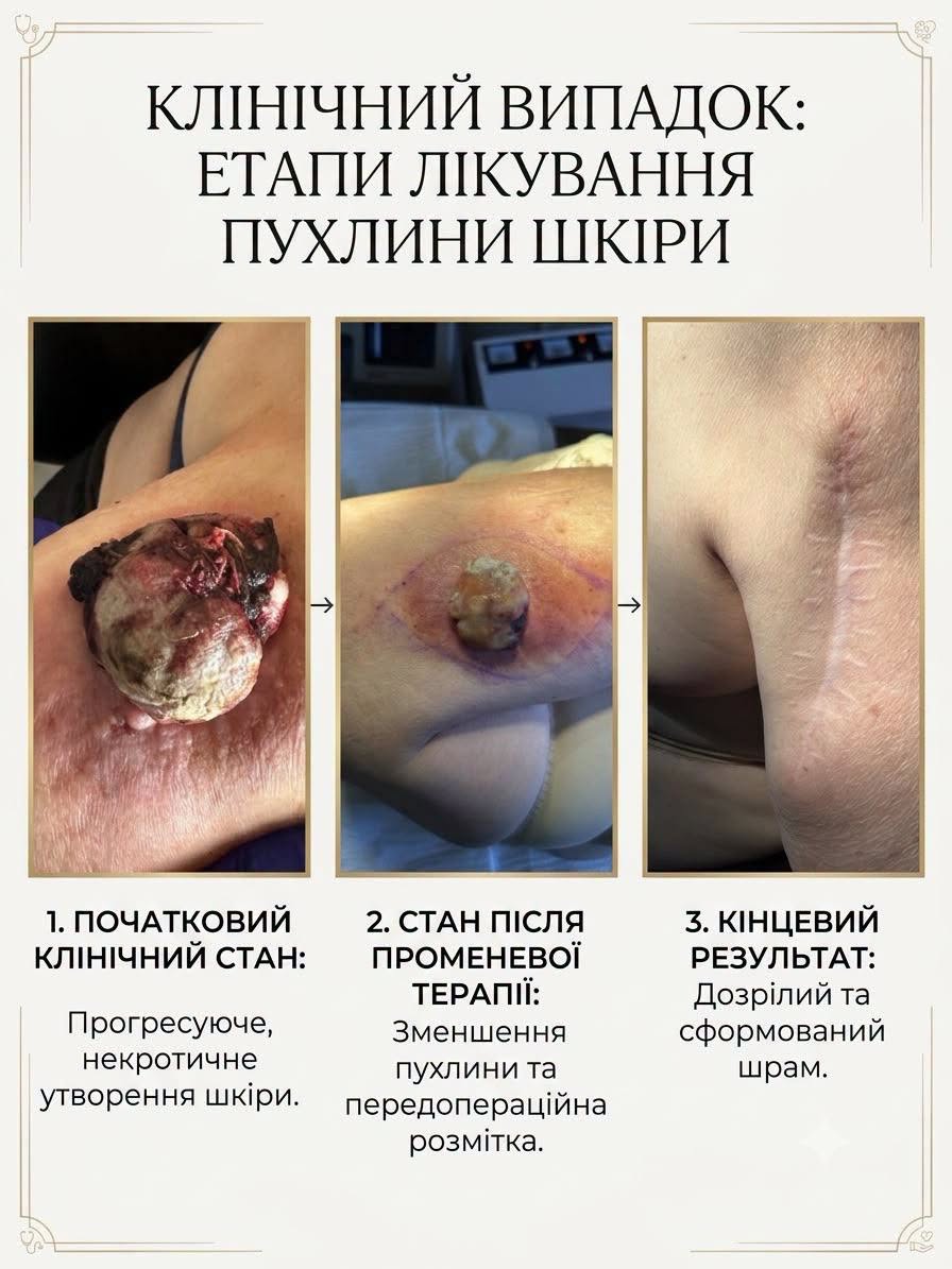 Могла здаватися звичайною папіломою: у Франківську жінці видалили злоякісну пухлину (ФОТО)