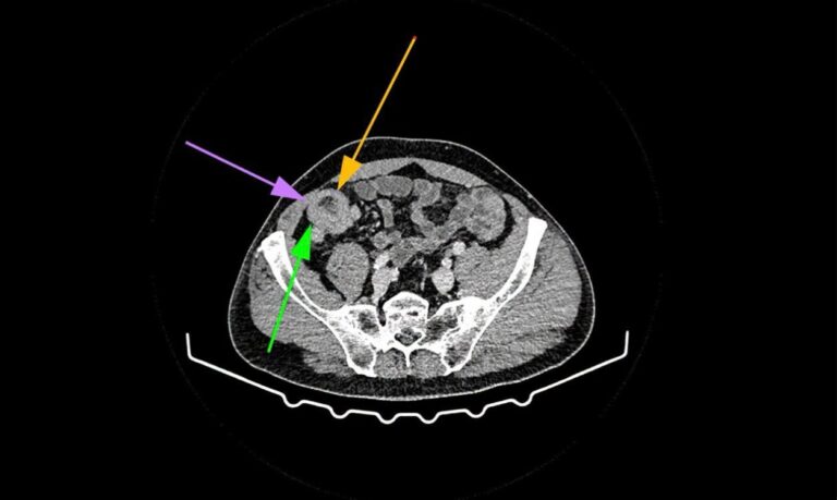 У Франківському онкоцентрі прооперували пацієнта з рідкісною пухлиною тонкої кишки